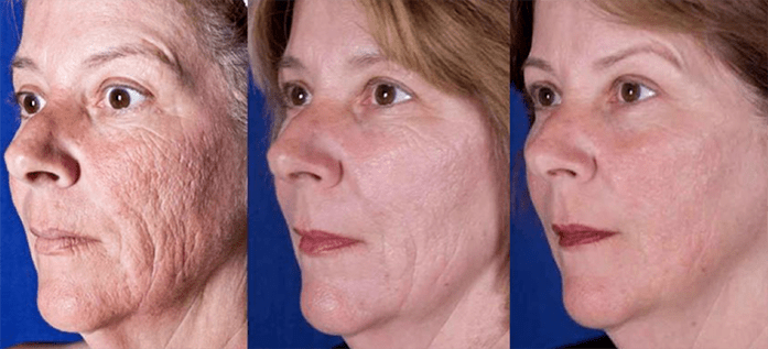 Výsledok po laserovom omladení pokožky tváre