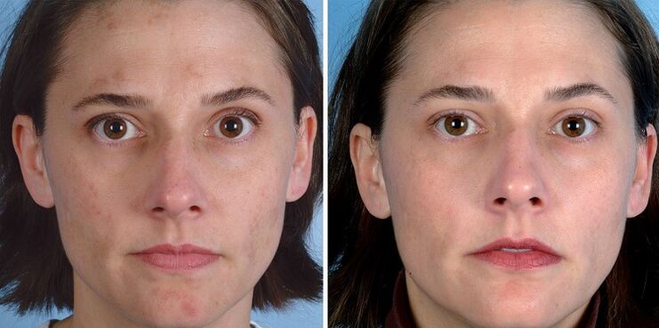 pred a po omladení pokožky prístrojom